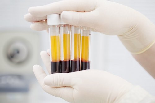 prp-tedavisi