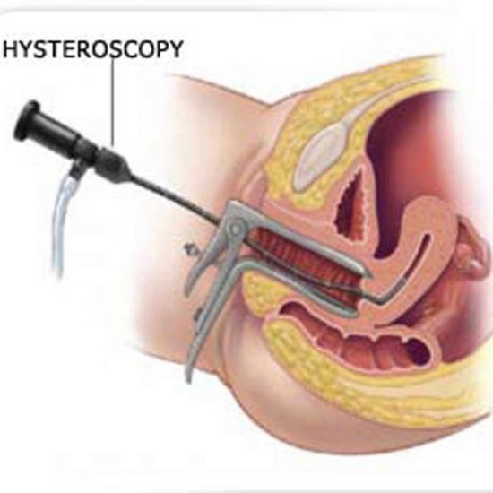 histeroskopi