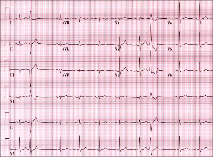 ekg