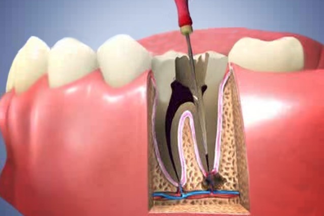 Endodontics (Root Canal Operation) | İstanbul Özel Kaş Tıp Merkezi