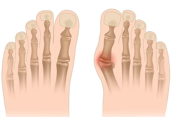 halluks valgus