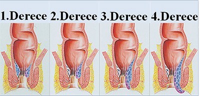 hemoroid dereceleri