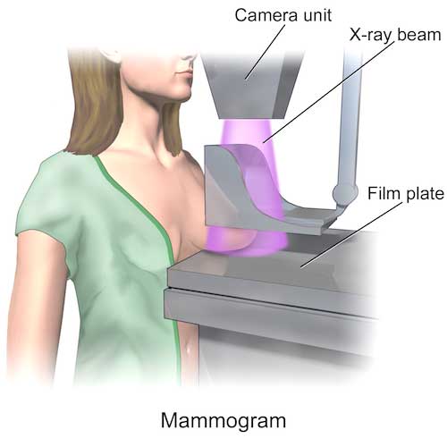 mamografi