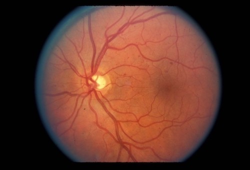 retinopati