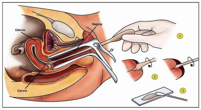 smear testi