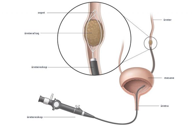 üreterorenoskopi