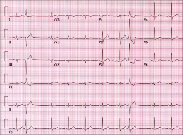 ekg-600×442