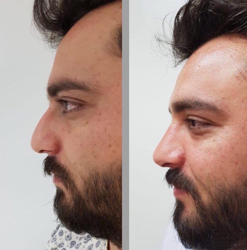 Burun Estetiği Fiyatları, Rinoplasti 2024 Güncel Ortalama