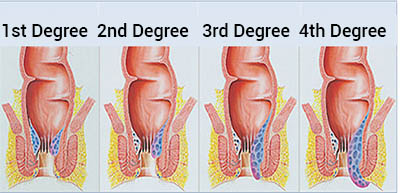 hemorrhoids