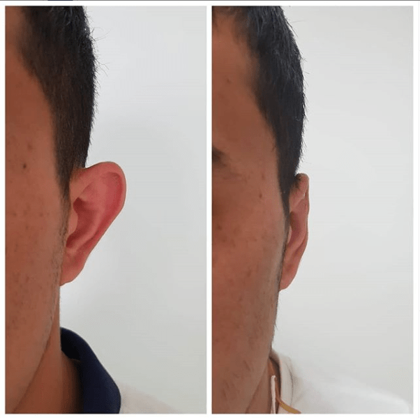 kulak estetiği kepçe kulak estetiği
